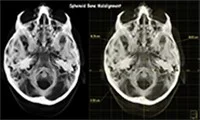 Xray